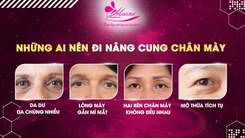 tác dụng của nâng cung chân mày