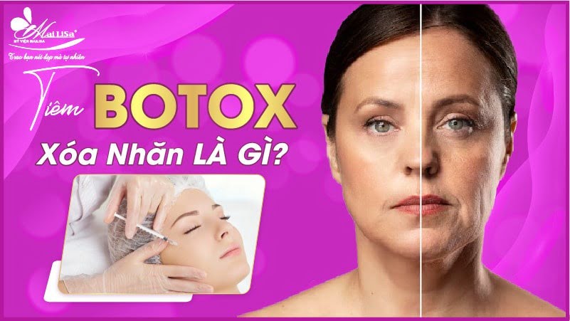 botox xoá nhăn