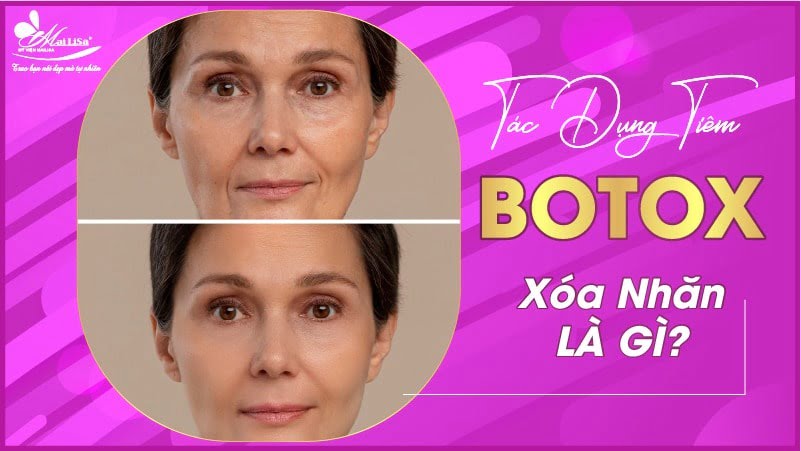 botox xoá nhăn