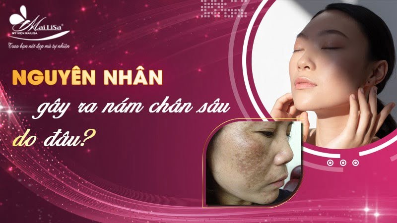 phác đồ điều trị nám chân sâu