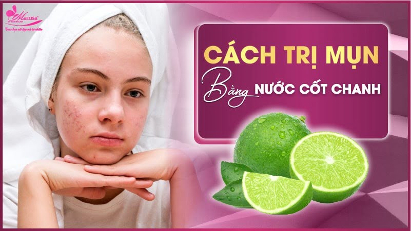 cách trị mụn tại nhà