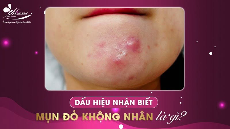 mụn đỏ không nhân