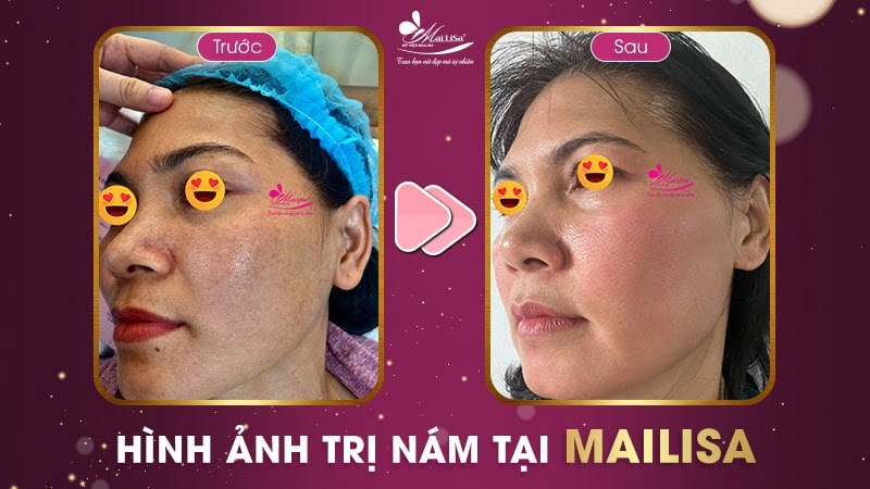 trị nám bằng dầu dừa