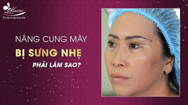 nâng cung chân mày bị sưng