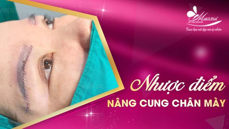 tác dụng của nâng cung chân mày