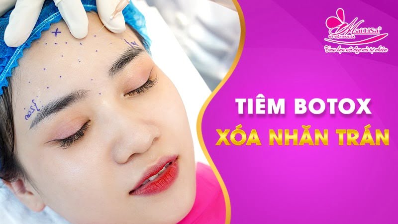 co-nen-tiem-botox-xoa-nhan