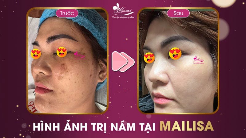 trị nám bằng dầu dừa