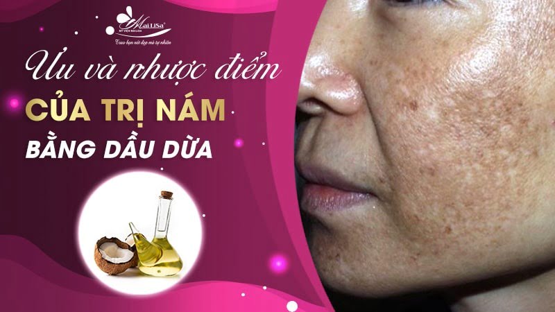 trị nám bằng dầu dừa