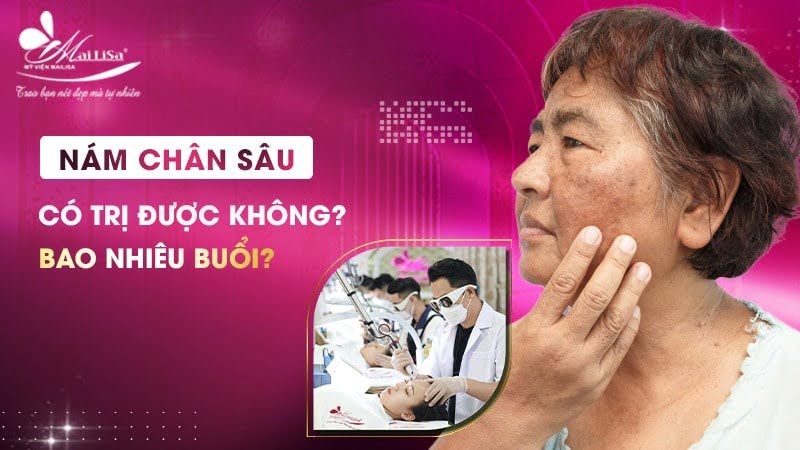 phác đồ điều trị nám chân sâu