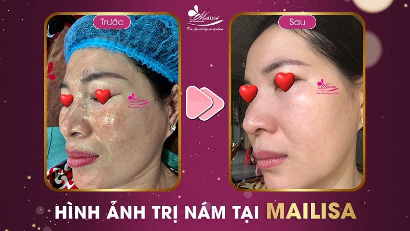 trị nám bằng dầu dừa