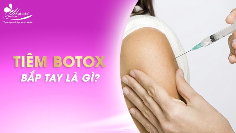 tiêm botox bắp tay