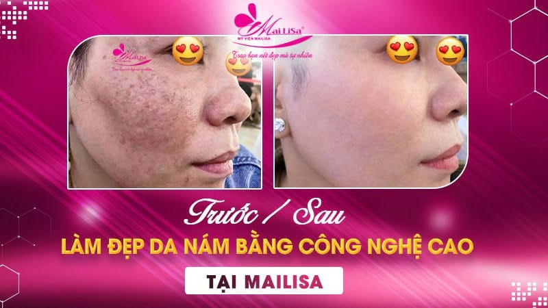 phác đồ điều trị nám chân sâu