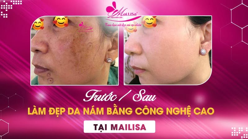 phác đồ điều trị nám chân sâu