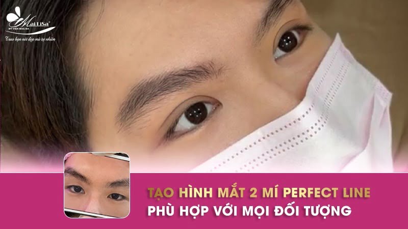 cắt mí ấn độ