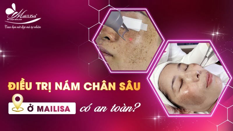 phác đồ điều trị nám chân sâu