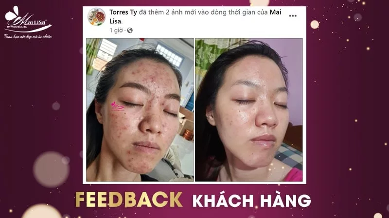 mụn đỏ không nhân