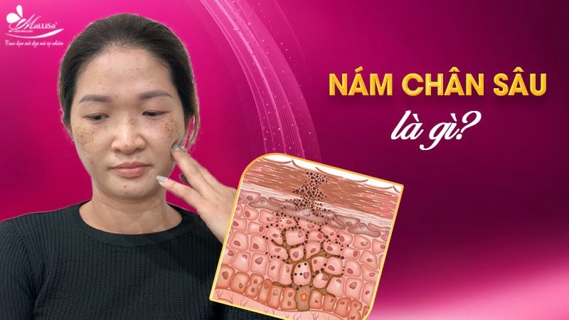 phác đồ điều trị nám chân sâu