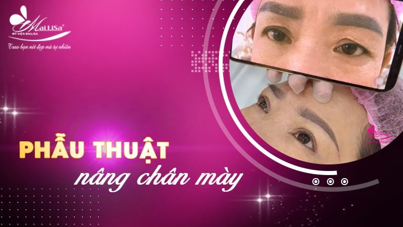 tác dụng của nâng cung chân mày