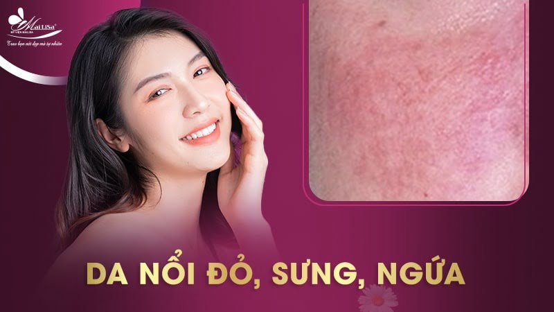 cách trị vết thâm sau khi bắn laser