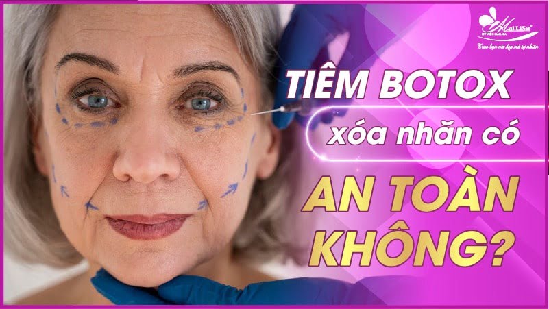 botox xoá nhăn