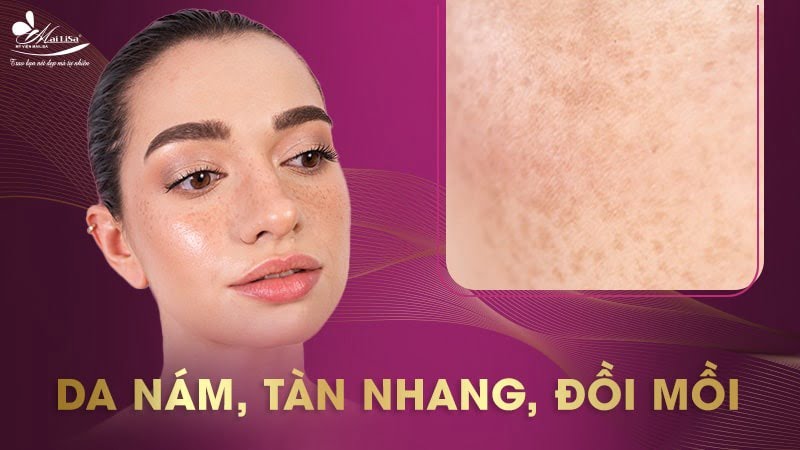 cách trị vết thâm sau khi bắn laser