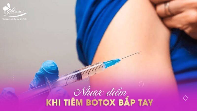 tiêm botox bắp tay