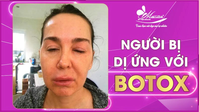 botox xoá nhăn