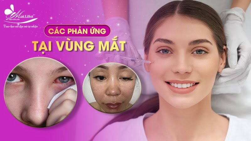 tiêm botox có ảnh hưởng gì không