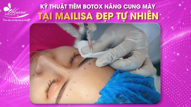 tiêm botox nâng cung chân mày