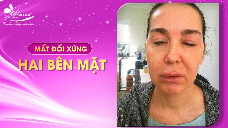 tiêm botox có ảnh hưởng gì không