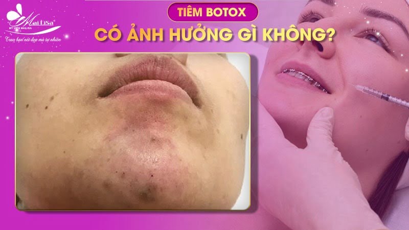 tiêm botox có ảnh hưởng gì không