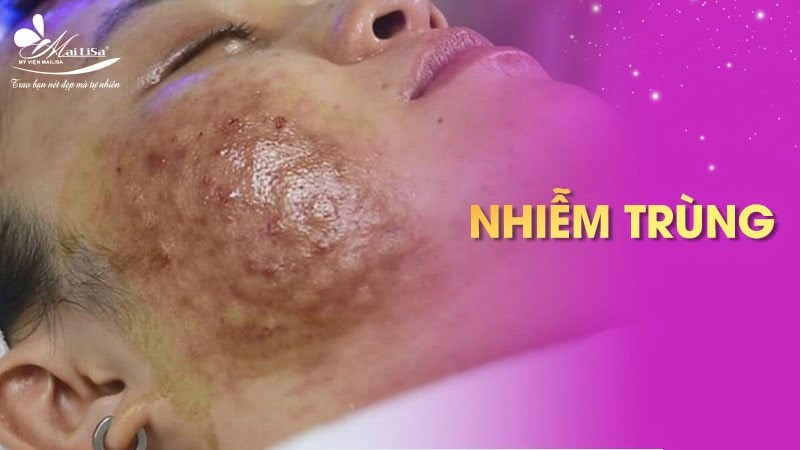 tiêm botox có ảnh hưởng gì không