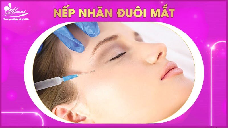 botox xoá nhăn