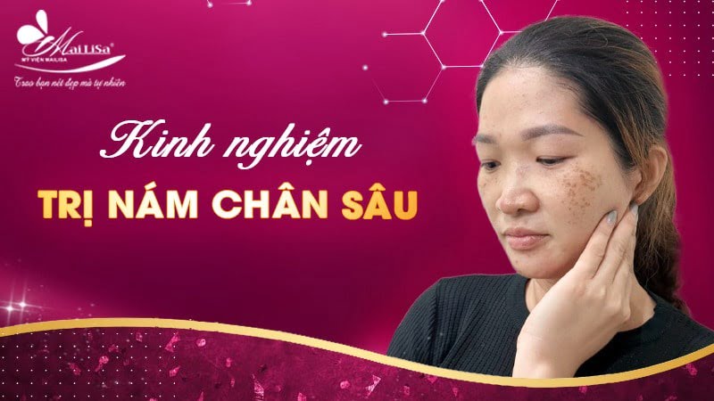 phác đồ điều trị nám chân sâu