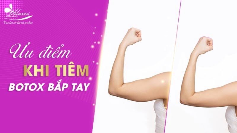 tiêm botox bắp tay