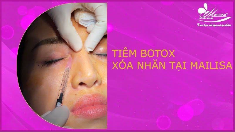 botox xoá nhăn