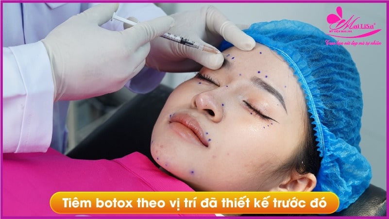 bieu-hien-sau-khi-tiem-botox-gon-ham