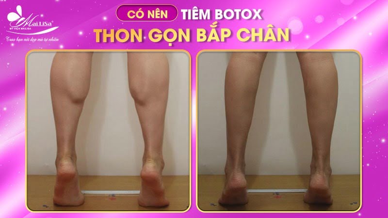 botox-my-gia-bao-nhieu