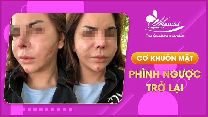 tac-hai-sau-khi-tiem-botox-gon-mat