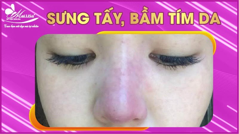 tiem-botox-gon-mat-gay-sung-tay