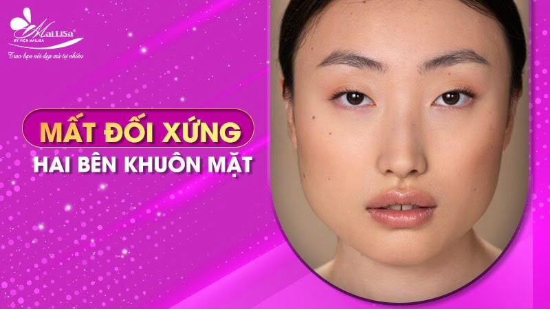 tiem-botox-kieng-gi