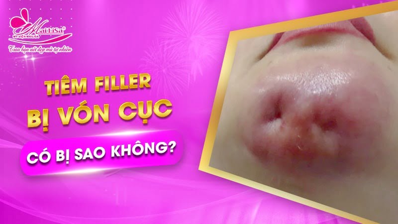 tiem-filler-moi-bi-von-cuc-co-sao-khong