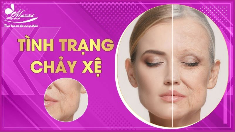 tinh-trang-chay-xe-khi-tiem-botox