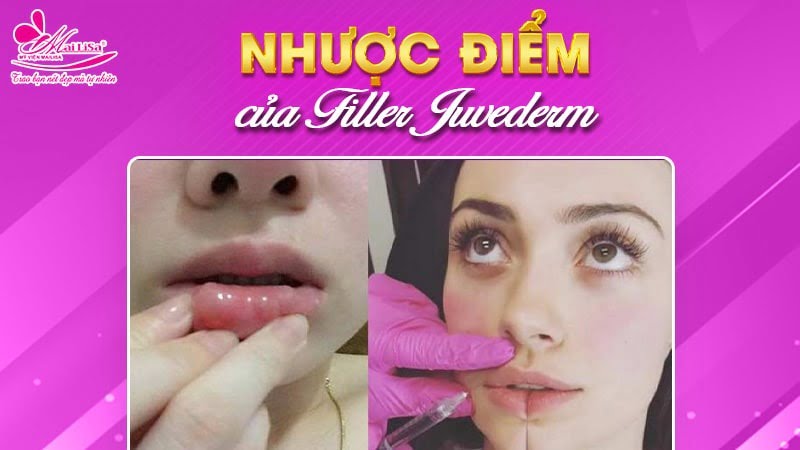 juvederm-cua-nuoc-nao