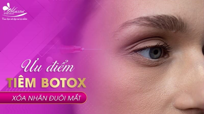 botox-my-gia-bao-nhieu