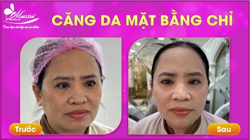 cang-da-mat-bang-chi-collagen