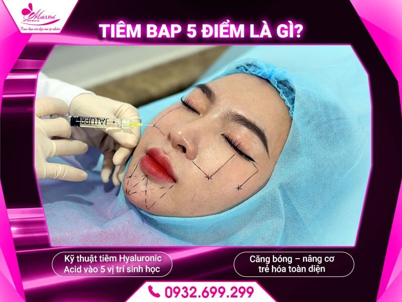 tiem-bap-5-diem-la-gi