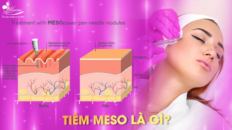 tiem-meso-co-an-toan-khong-1