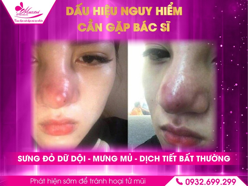 dau-hieu-bat-thuong-sau-nang-mui