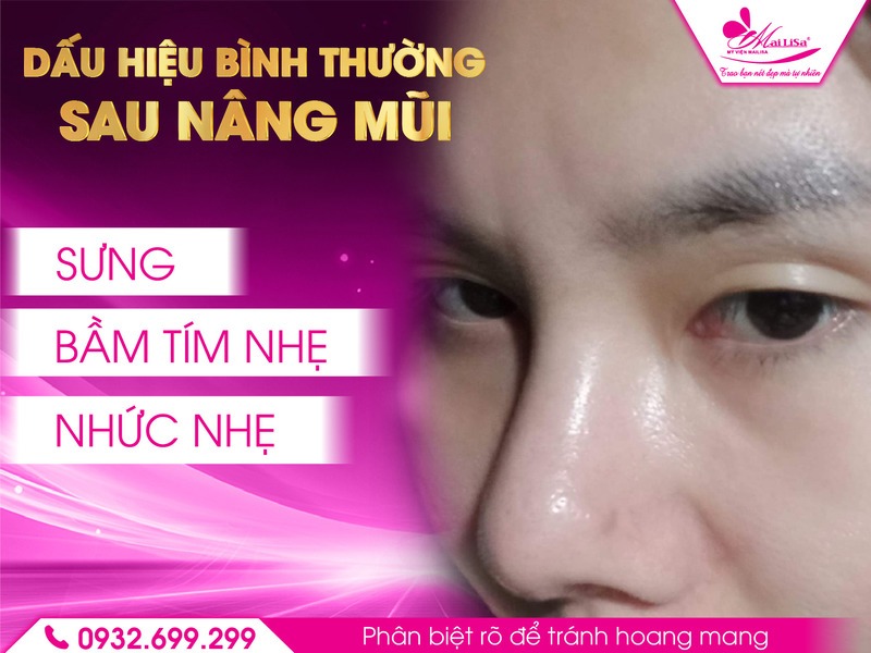 dau-hieu-bat-thuong-sau-nang-mui